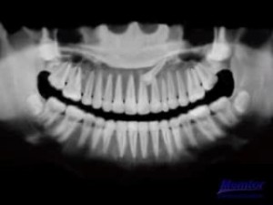 Radiographie - traction orthodontique d'une canine incluse :