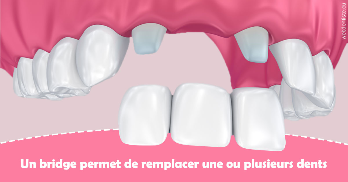 https://dr-cardinaux-laurent.chirurgiens-dentistes.fr/Bridge remplacer dents 2