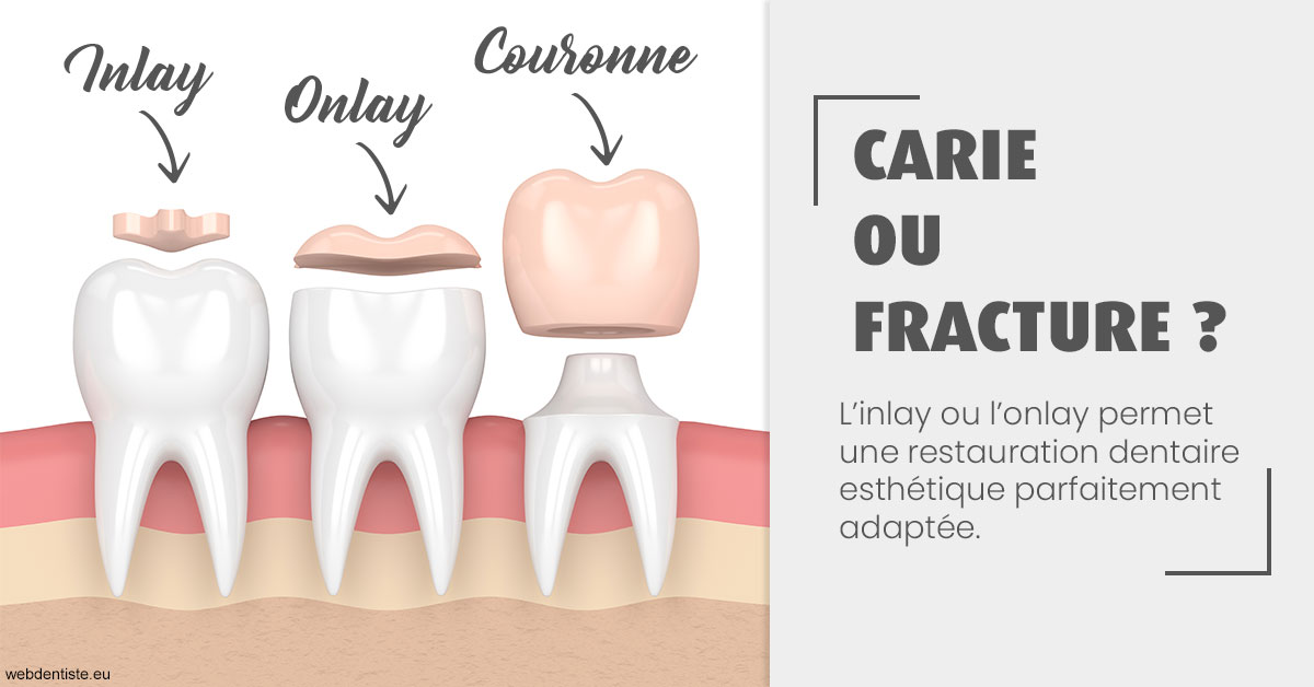 https://dr-cardinaux-laurent.chirurgiens-dentistes.fr/T2 2023 - Carie ou fracture 1