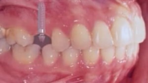 Agénésie de la 2nd prémolaire - Traitement par un implant