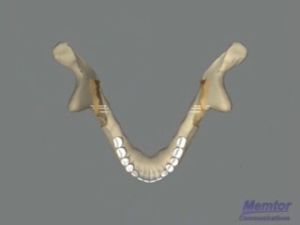 Avancée mandibulaire - Vue osseuse 1