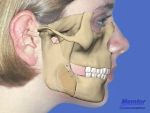 Recul mandibulaire - Vue osseuse 2