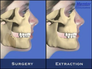 Recul mandibulaire - Vue osseuse 4