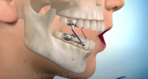 Herbst Device to Correct Overbite - Chvatal Orthodontics