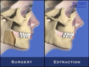 Avancée mandibulaire - Vue osseuse 2