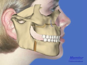 Avancée maxillaire + recul mandibulaire