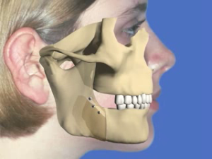 Recul mandibulaire - Vue osseuse 1