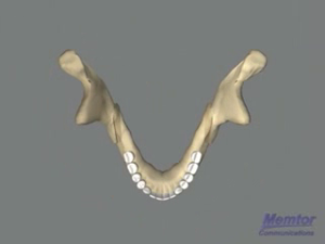 Recul mandibulaire - Vue osseuse 3